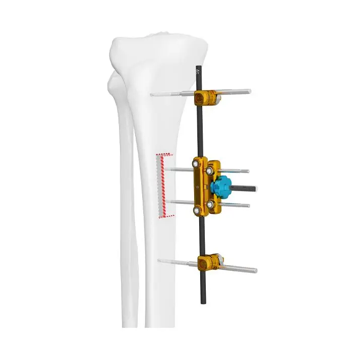 Double Medical horizontal transport external fixator