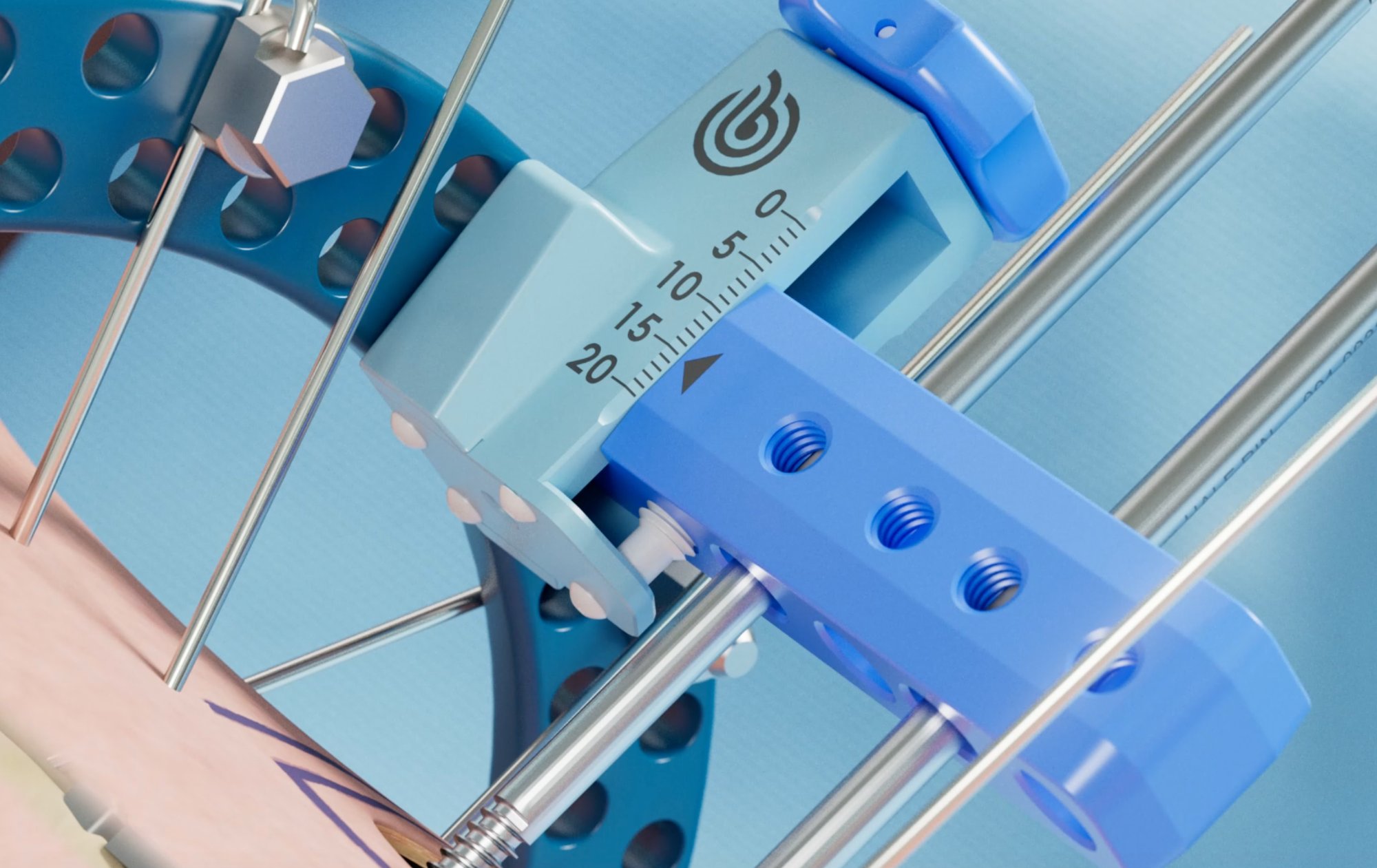Excelsior External Fixation System
